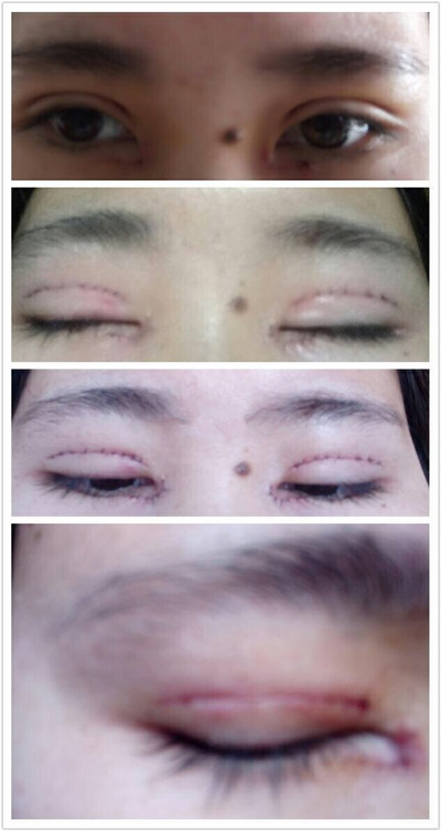 洛阳华美医疗美容医院宋俊岭做的双眼皮果