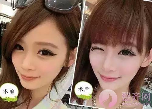 和闺蜜一起打玻尿酸,为什么我比她吸收快?
