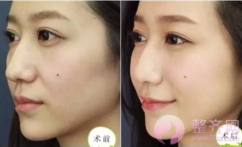 和闺蜜一起打玻尿酸,为什么我比她吸收快?