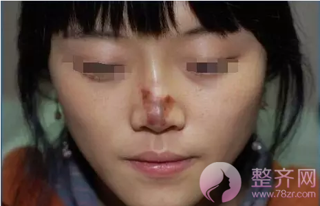 和闺蜜一起打玻尿酸,为什么我比她吸收快?