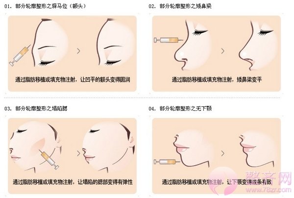 注射完玻尿酸后,应该注意哪些问题?