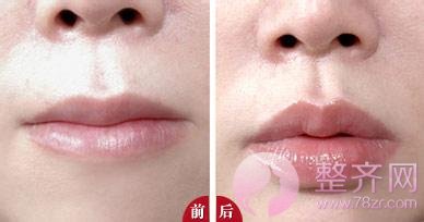 注射完玻尿酸后,应该注意哪些问题?