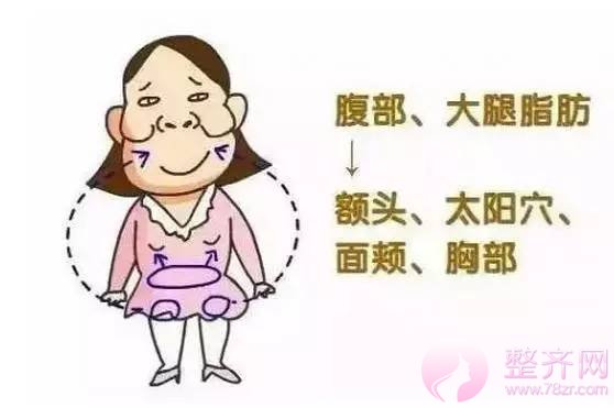 自体脂肪移植那些事?