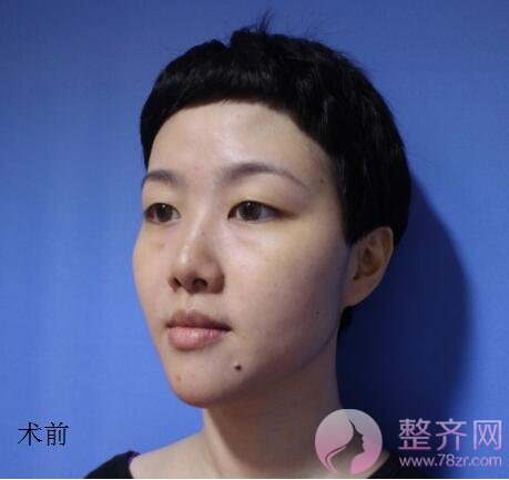 做完玻尿酸隆鼻,什么时候可以再做假体隆鼻呢