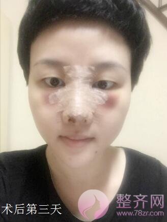 做完玻尿酸隆鼻,什么时候可以再做假体隆鼻呢