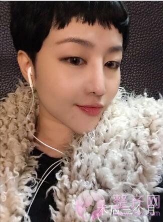 做完玻尿酸隆鼻,什么时候可以再做假体隆鼻呢