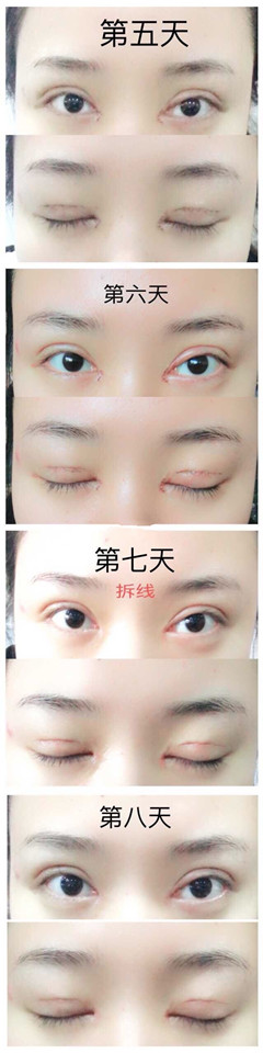 南京凤凰岛吕启凤医生做的双眼皮修复手术