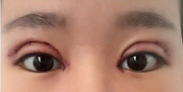 全切双眼皮手术+开内眼角手术+眶隔释放去眼袋