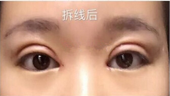 全切双眼皮手术+开内眼角手术+眶隔释放去眼袋