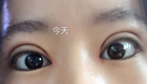 全切双眼皮手术+开内眼角手术+眶隔释放去眼袋