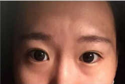 全切双眼皮手术+开内眼角手术+眶隔释放去眼袋