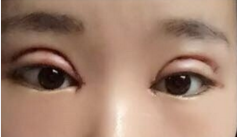 全切双眼皮手术+开内眼角手术+眶隔释放去眼袋