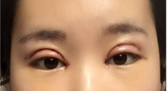 全切双眼皮手术+开内眼角手术+眶隔释放去眼袋