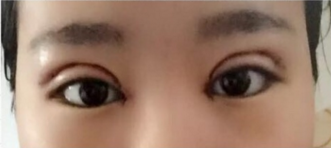 全切双眼皮手术+开内眼角手术+眶隔释放去眼袋
