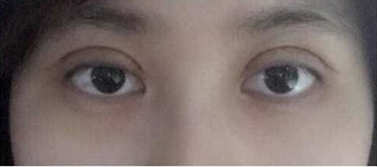 厦门大学附属第一医院做的双眼皮手术