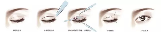 想脱“单”的看过来:双眼皮手术过程