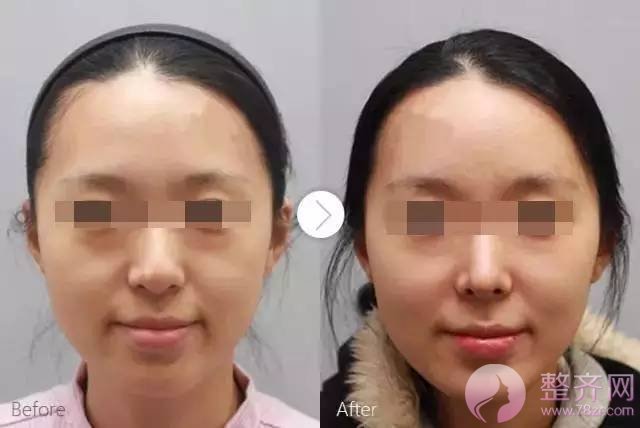 面部美不美,关键看鼻子
