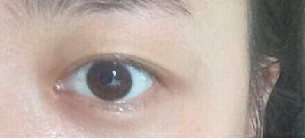 上海九院周一熊医生做的双眼皮手术