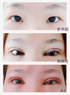 武汉天佑医院李芸医生做的双眼皮开眼角手术案