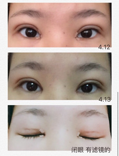 武汉天佑医院李芸医生做的双眼皮开眼角手术案