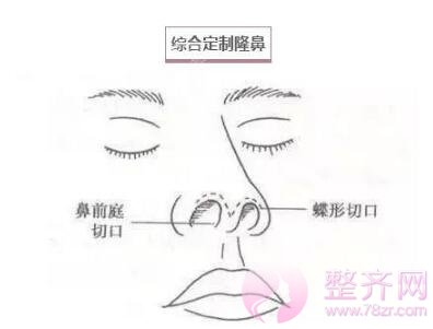 你是适合做隆鼻还是鼻部手术?
