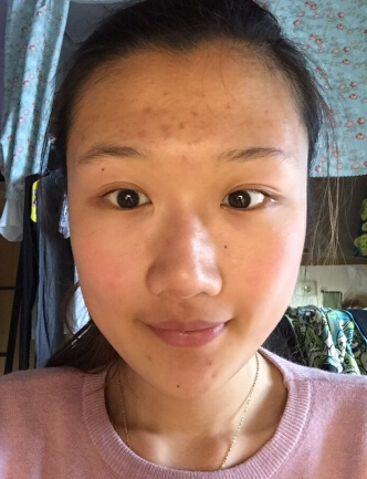 做额头究竟是假体还是自体脂肪呢?