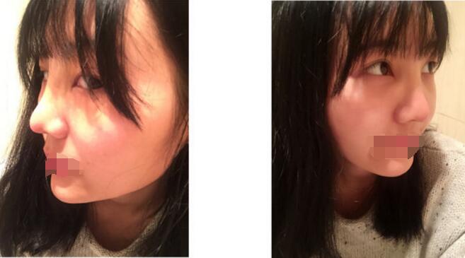 武汉隆鼻案例 武汉求美者隆鼻案例日记-对比图