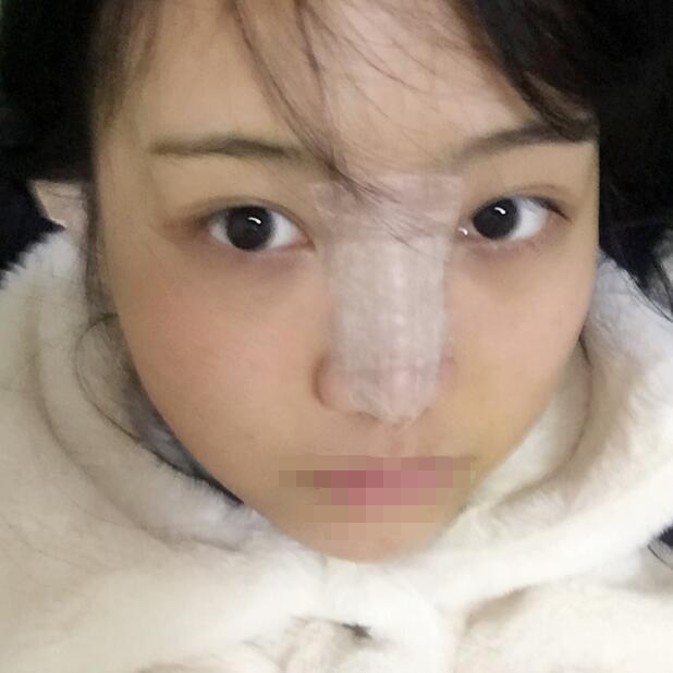 武汉隆鼻案例 武汉求美者隆鼻案例日记-对比图
