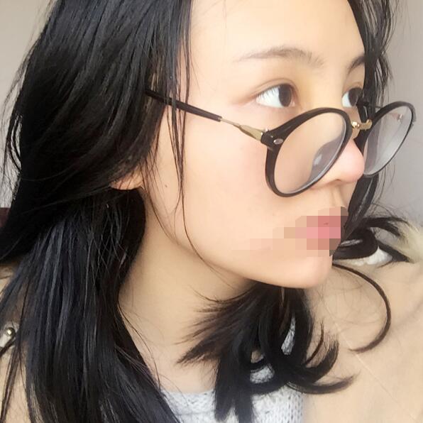 武汉隆鼻案例 武汉求美者隆鼻案例日记-对比图