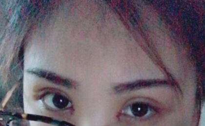 杭州静港整形医院林主任做的双眼皮开眼角