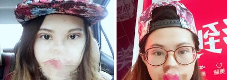 双眼皮案例 一位求美者的双眼皮案例分享-案例图
