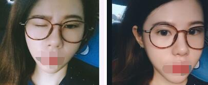 双眼皮案例 一位求美者的双眼皮案例分享-案例图