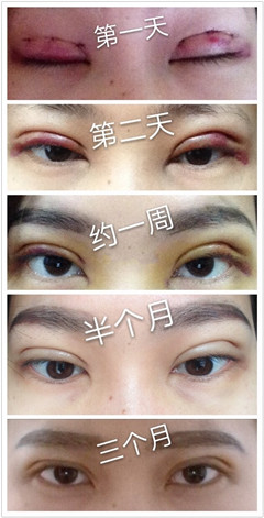 韩式微创三点线条不流畅是否需要修复?