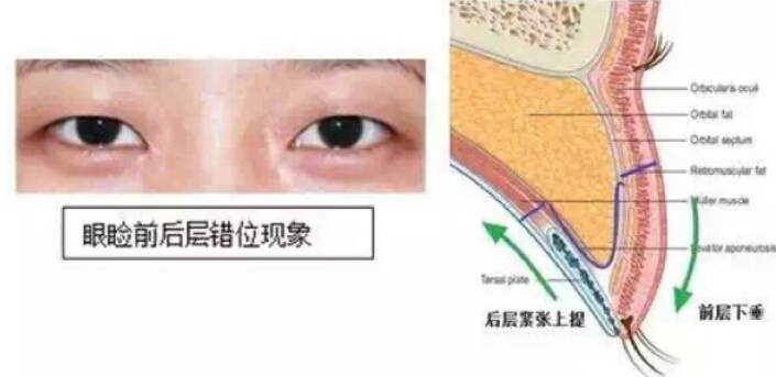 韩式微创三点线条不流畅是否需要修复?