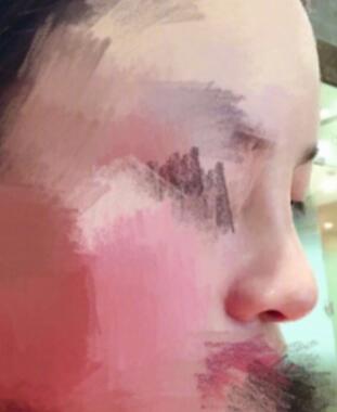 虽然在私立医院做的,但鼻子很自然
