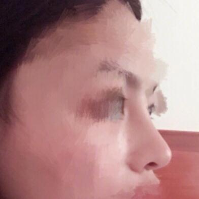 虽然在私立医院做的,但鼻子很自然