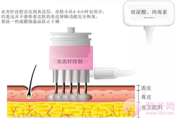 水光补水和玻尿酸的区别在哪?
