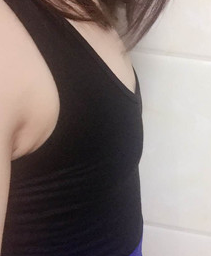北京侯泽民医生做的自体脂肪隆胸,果很满意