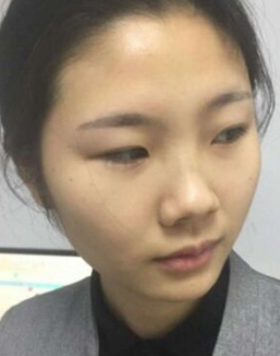 南京做鼻部手术整形哪里好?看看我的分享吧!