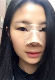 南京做鼻部手术整形哪里好?看看我的分享吧!