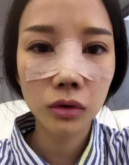 在成都做的鼻部手术手术,看看果怎么样!