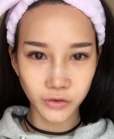 在成都做的鼻部手术手术,看看果怎么样!
