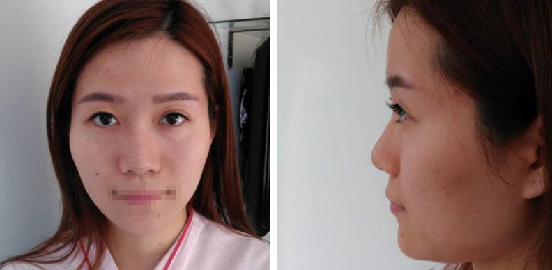 自体脂肪填充额头案例 自体脂肪填充丰额头案例
