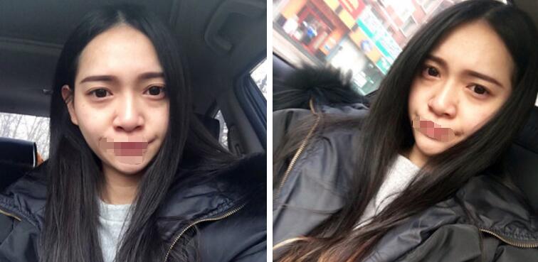去眼袋案例图 去眼袋果好不好?去眼袋案例