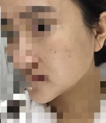 分别做了颧骨和下颌角手术,小脸就是美