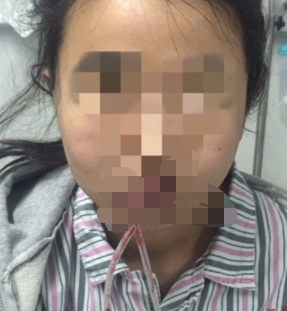 分别做了颧骨和下颌角手术,小脸就是美