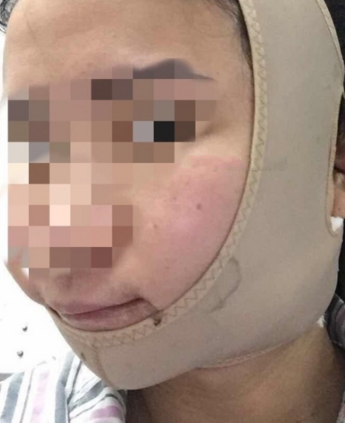 分别做了颧骨和下颌角手术,小脸就是美