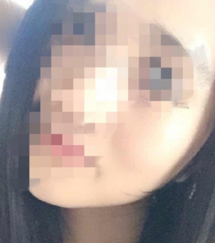 分别做了颧骨和下颌角手术,小脸就是美