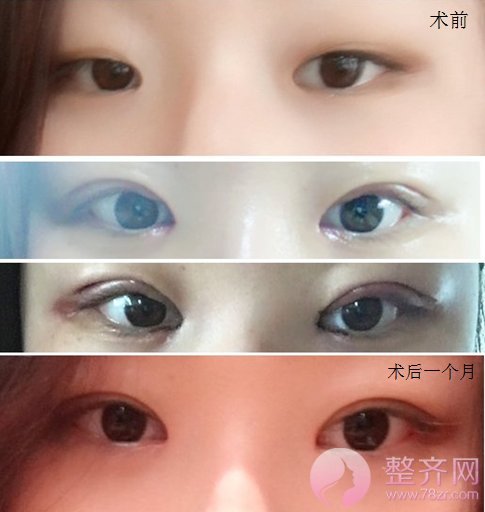 割双眼皮CG高不高?术后护理很重要!