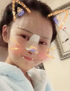 做了面部填充和隆鼻,恢复越来越自然了~